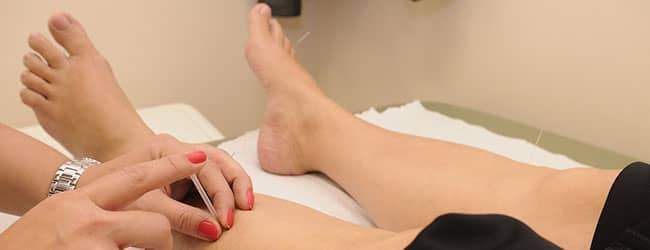 acupuntura